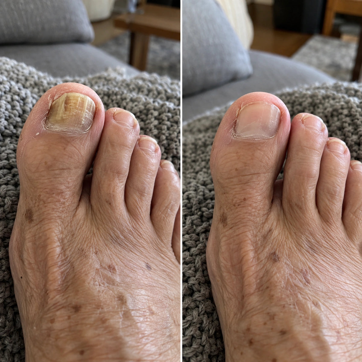 Antes e depois da unha do dedao-4