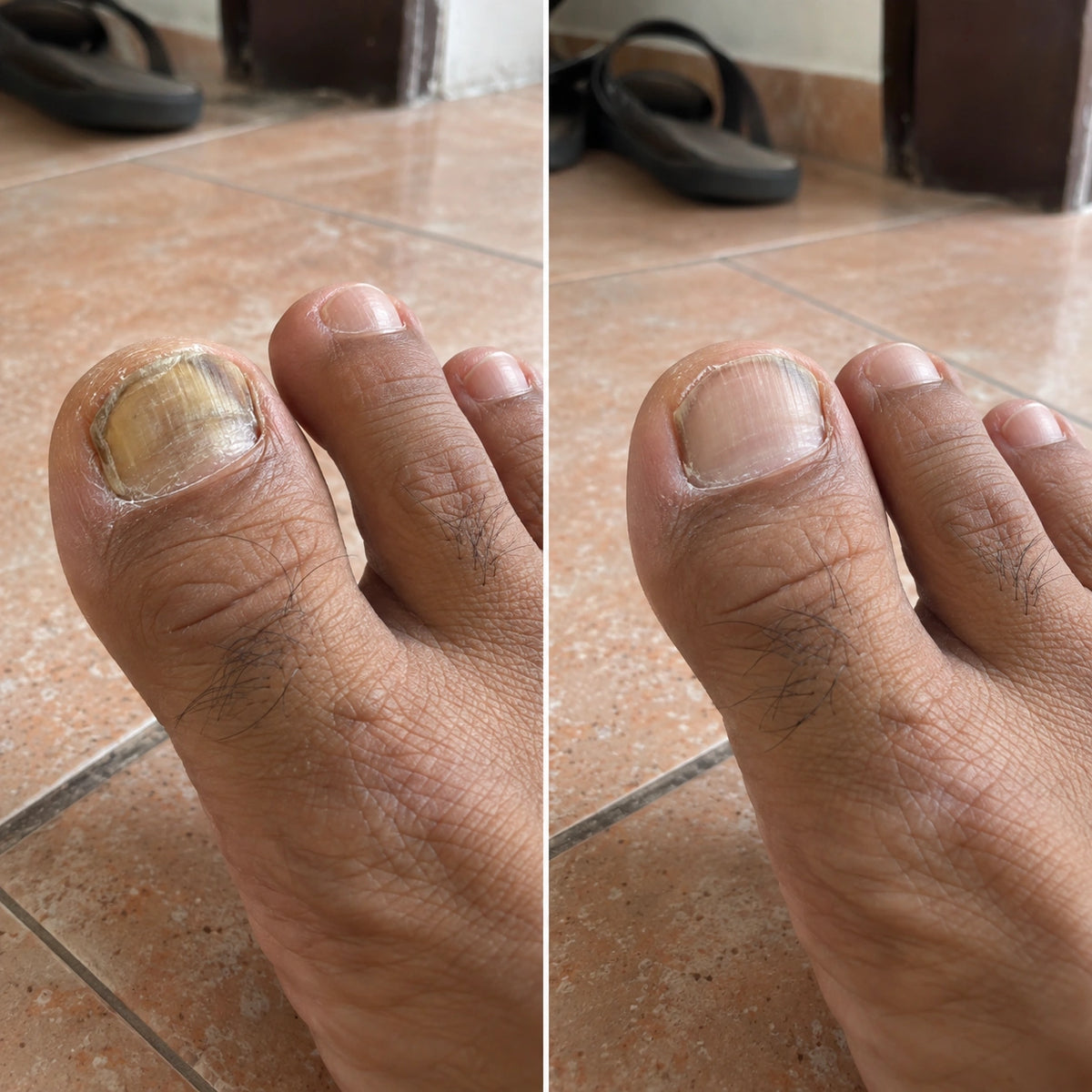 Antes e depois da unha do dedao-6