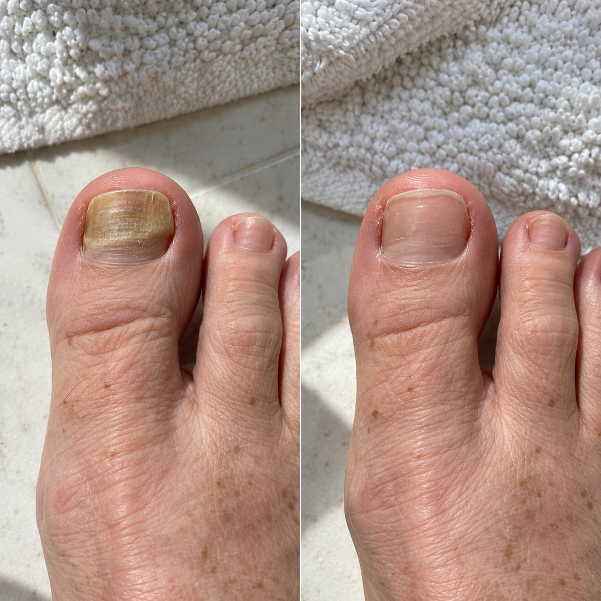 Unha do dedao  antes e depois-1